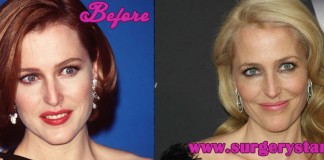 Gillian Anderson Plastic Surgery