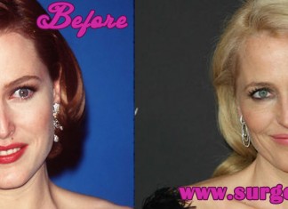 Gillian Anderson Plastic Surgery