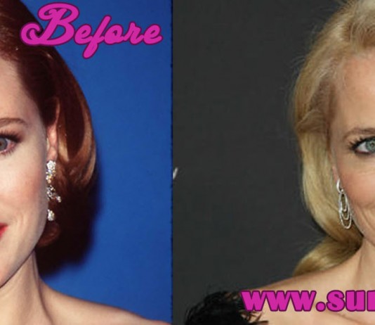 Gillian Anderson Plastic Surgery