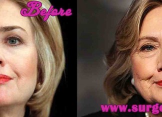 hillary clinton Facelift