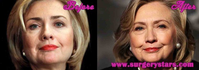 hillary clinton Facelift