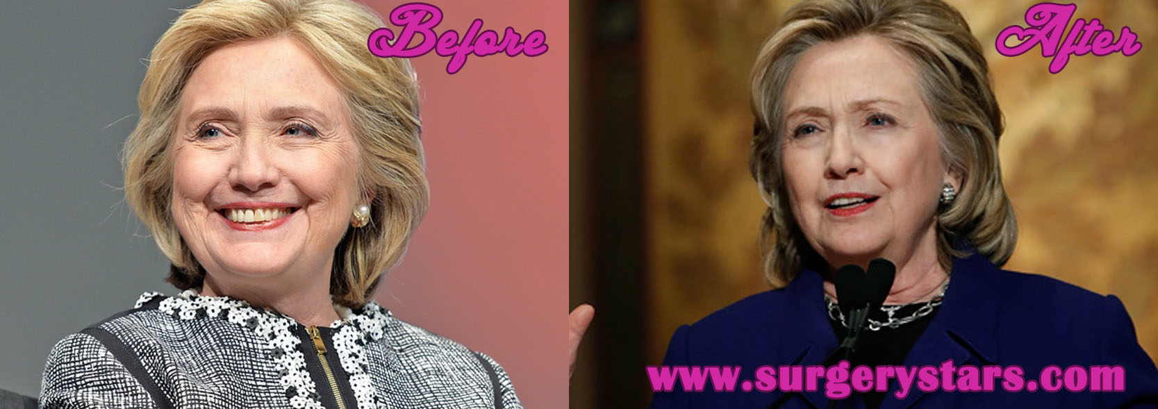 Hillary Clinton Facelift Surgerystars 3135