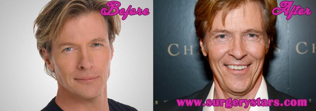 Jack Wagner Plastic Surgery