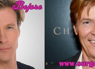 Jack Wagner Plastic Surgery