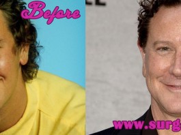 Judge Reinhold Plastic Surgery