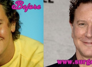 Judge Reinhold Plastic Surgery
