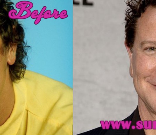Judge Reinhold Plastic Surgery