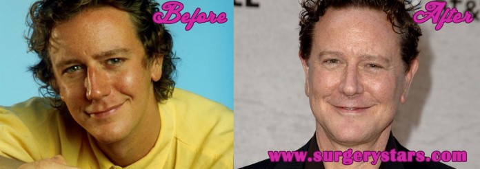 Judge Reinhold Plastic Surgery