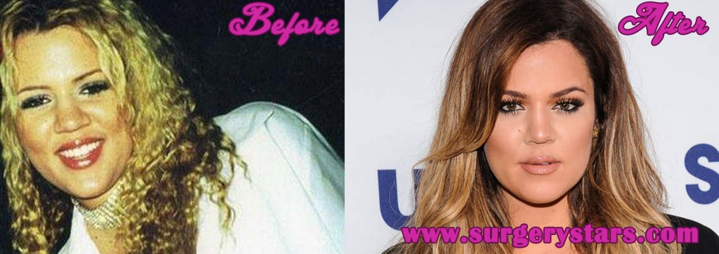 Khloe Kardashian Plastic Surgery Pictures