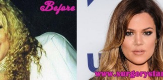 Khloe Kardashian Plastic Surgery