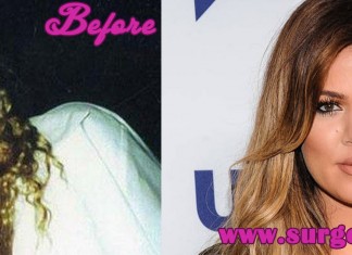 Khloe Kardashian Plastic Surgery