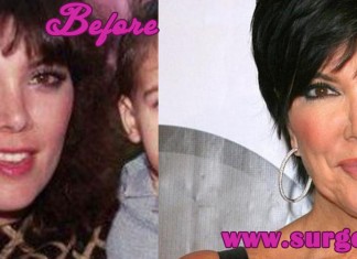 Kris Kardashian Plastic Surgery