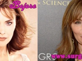 Lauren Koslow Plastic Surgery