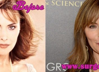 Lauren Koslow Plastic Surgery