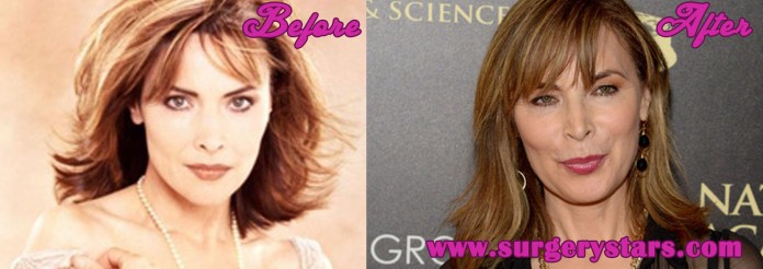 Lauren Koslow Plastic Surgery