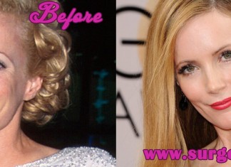 leslie mann plastic surgery