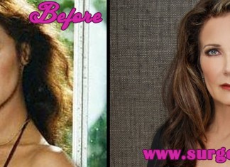 Lynda Carter Plastic Surgery