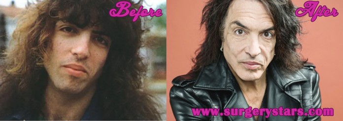 Paul Stanley Plastic Surgery