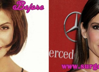 Sandra Bullock Plastic Surgery