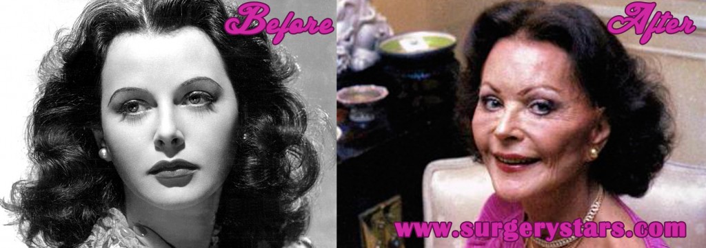 Hedy Lamarr Plastic Surgery