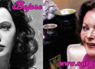 Hedy Lamarr Plastic Surgery