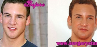 Ben Savage Nose Job