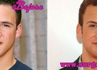 Ben Savage Nose Job