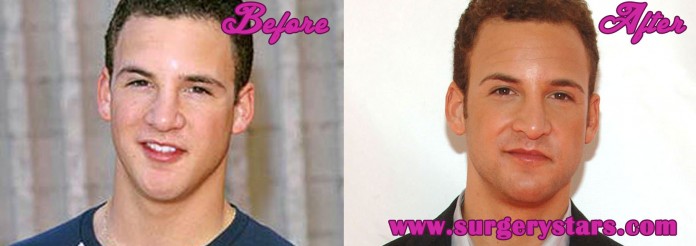 Ben Savage Nose Job