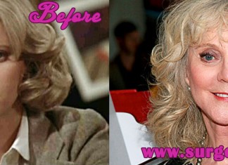 Blythe Danner Plastic Surgery