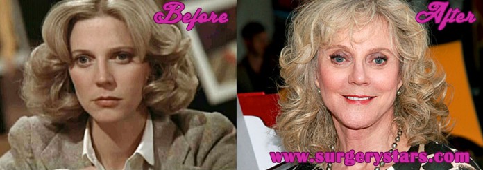 Blythe Danner Plastic Surgery