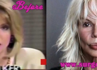 Bree Walker Plastic Surgery