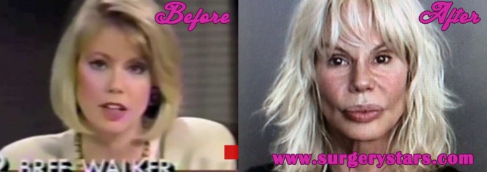 Bree Walker Plastic Surgery