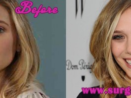 Elizabeth Olsen Nose Job