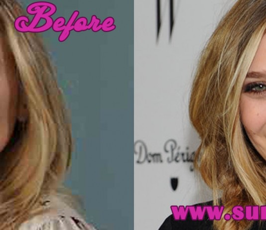 Elizabeth Olsen Nose Job