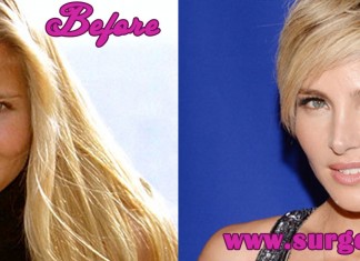 Elsa Pataky Plastic Surgery