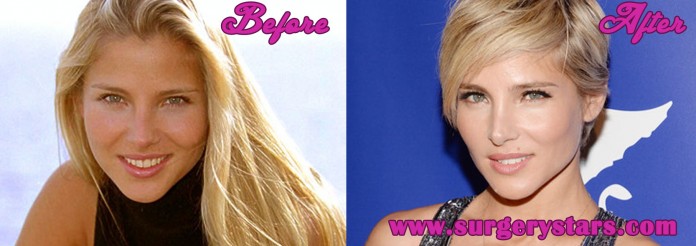 Elsa Pataky Plastic Surgery