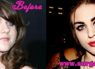 Frances Bean Cobain Plastic Surgery