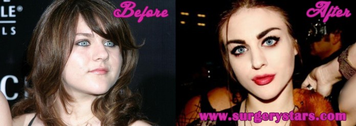 Frances Bean Cobain Plastic Surgery