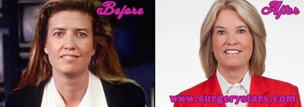 Greta Van Susteren Before and after