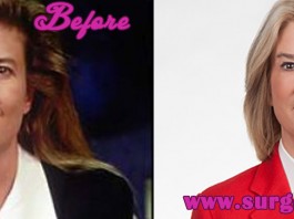 Greta Van Susteren Before and after