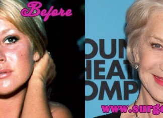 Helen Mirren Plastic Surgery