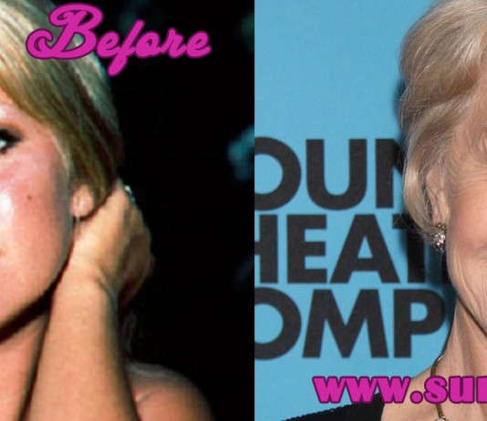 Helen Mirren Plastic Surgery