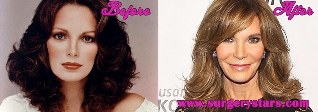 Jaclyn Smith Plastic Surgery