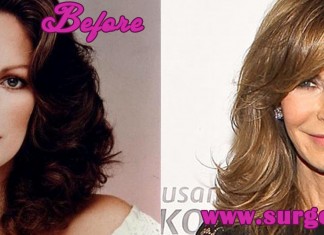 Jaclyn Smith Plastic Surgery