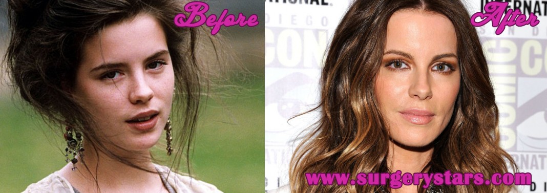 Kate Beckinsale Plastic Surgery Before And After Pic