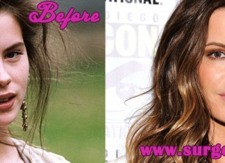 Kate Beckinsale Plastic Surgery