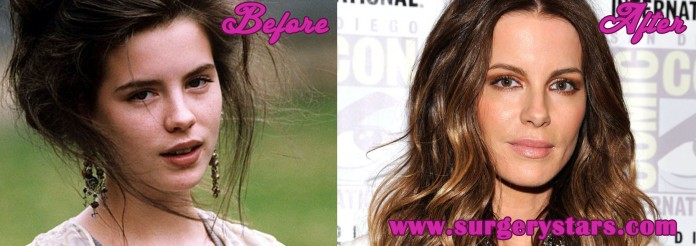 Kate Beckinsale Plastic Surgery