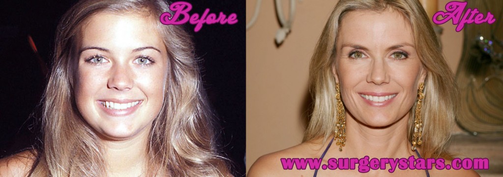 Katherine Kelly Lang Plastic Surgery