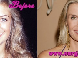 Katherine Kelly Lang Plastic Surgery