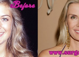 Katherine Kelly Lang Plastic Surgery